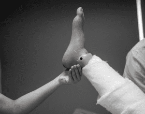 Jones Fracture