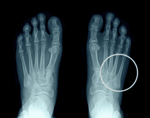 Jones Fracture